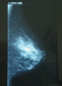 乳房Ｘ線写真