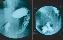 胃と大腸のX線写真