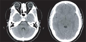頭部CT画像