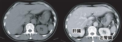 腹部単純CT画像と腹部造影CT画像