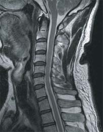 脊椎MRI写真1