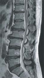 脊椎MRI写真2