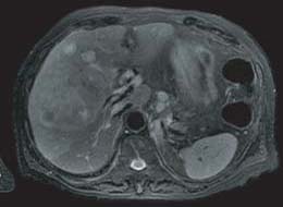 腹部MRI写真