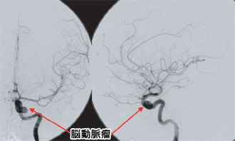 脳血管写真