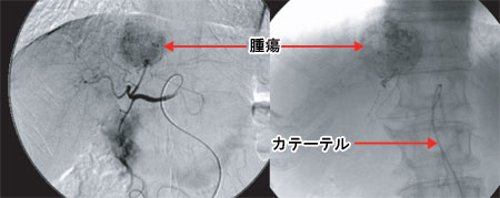 肝臓血管造影と腫瘍塞栓後の写真
