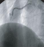 右冠動脈完全閉塞の写真1