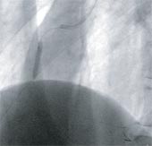 右冠動脈完全閉塞の写真2