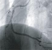右冠動脈完全閉塞の写真3
