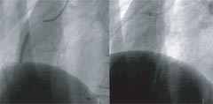右冠動脈完全閉塞の写真4