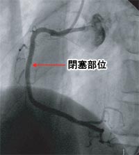 右冠動脈完全閉塞の写真5